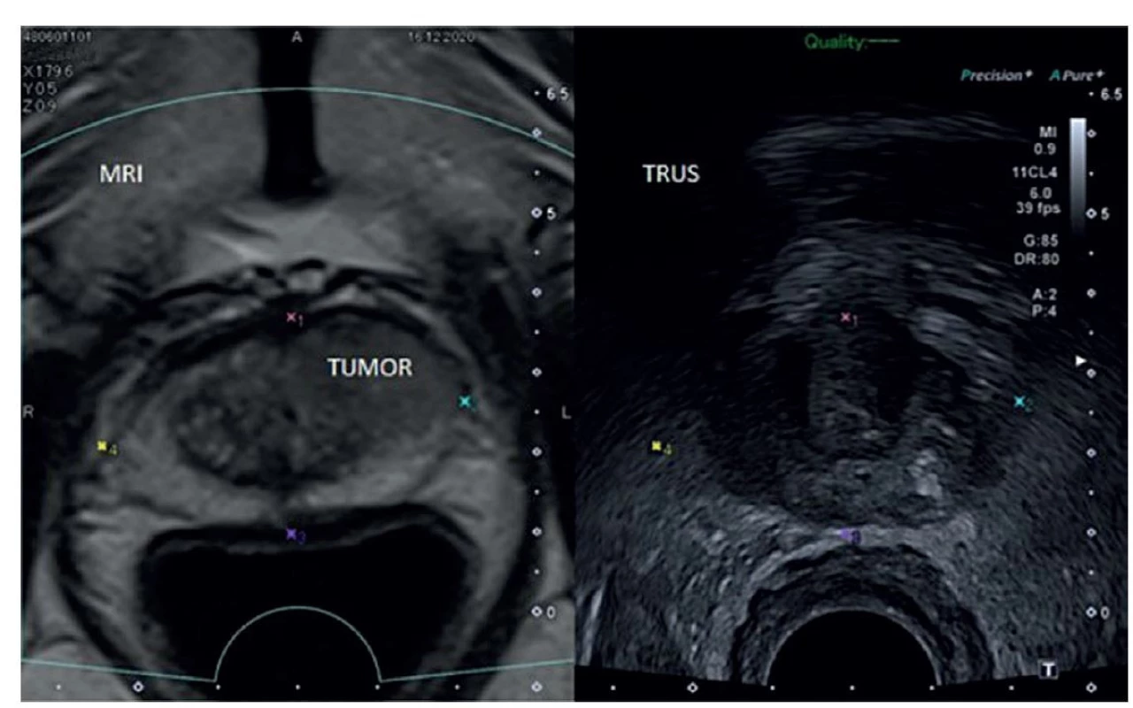 MRI/TRUS fúzní biopsie s ložiskem PI-RADS 5 v levém laloku ventrálně [61]<br>
Fig. 2: MRI/TRUS fusion biopsy with a PI-RADS 5 lesion in the anterior part of the left lobe [61]