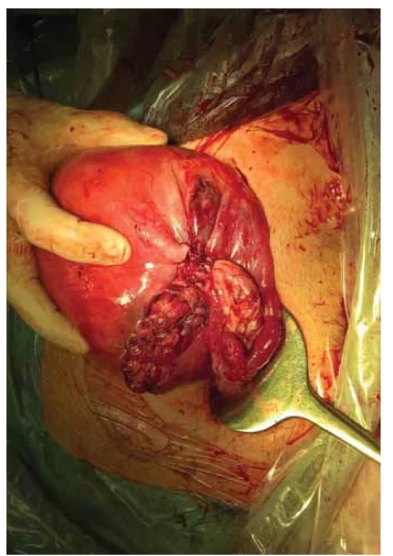 Uterotomie šita pokračovacím pleteným syntetickým
resorbovatelným stehem.<br>
Fig. 2. Uterotomy sewn with a continuous syntetic absorbable
braided stitch.