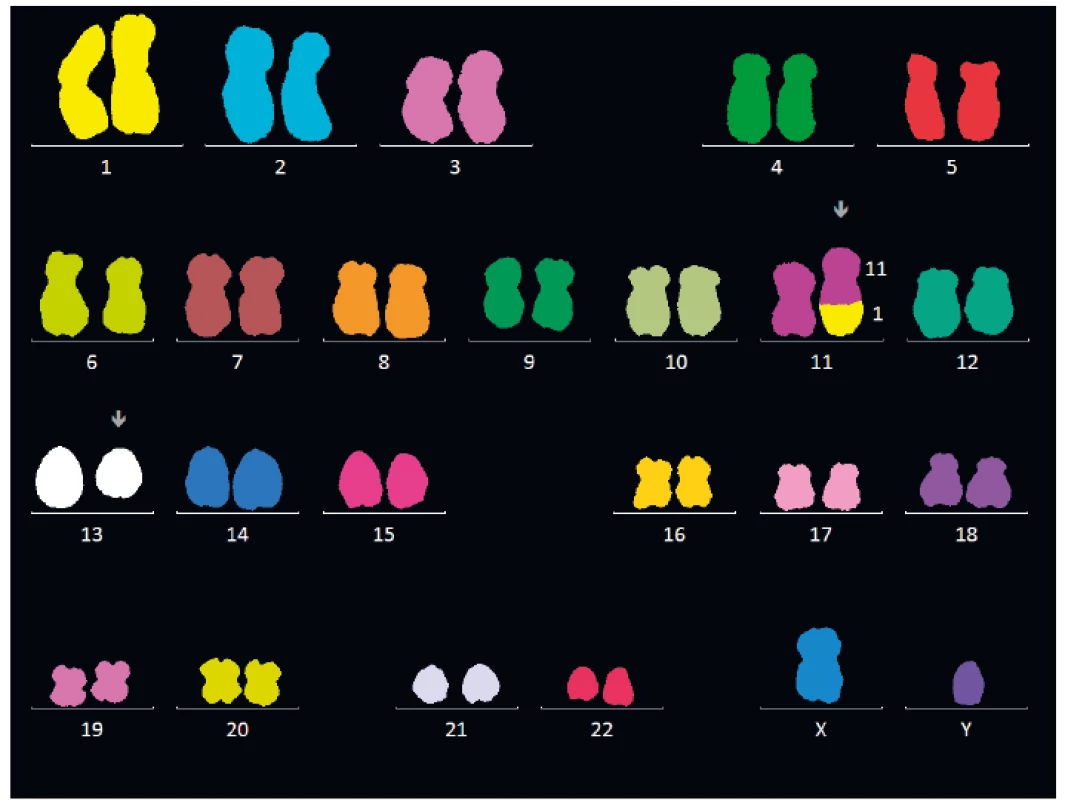 Vyšetření karyotypu nemocného s MDS pomocí mnohobarevné fluorescenční
hybridizace in situ (mFISH)