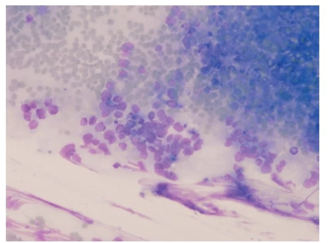 Cytologický vzhled malobuněčného plicního karcinomu. „Puzzling“
jader, granulovaný chromatin, nepřítomnost jadérek, mitotická aktivita.
Giemsa, 200x.
