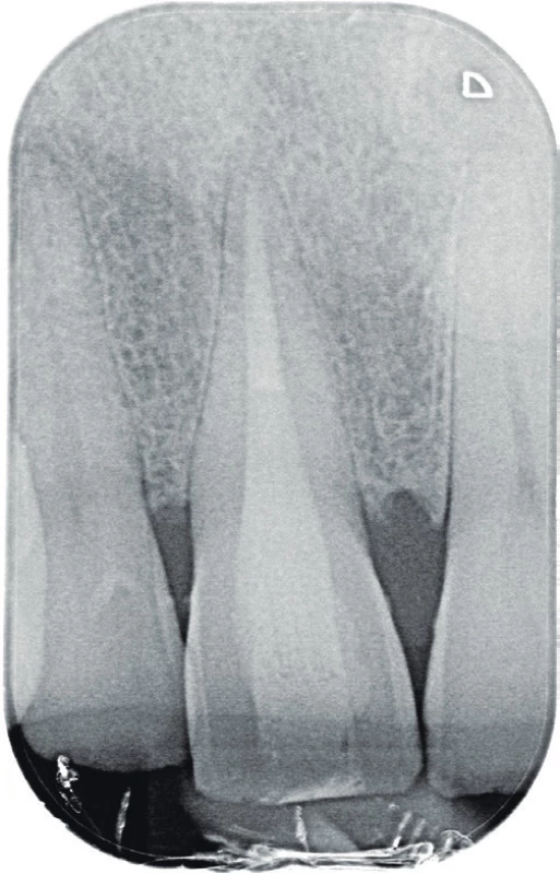 Diagnostický intraorální
rentgenový snímek
zubu 11 v apikálním zastavení
zhotovený dva roky po
reendodontickém ošetření
zubu 11. Je jasně viditelná
periodontální štěrbina bez
známek rozšíření