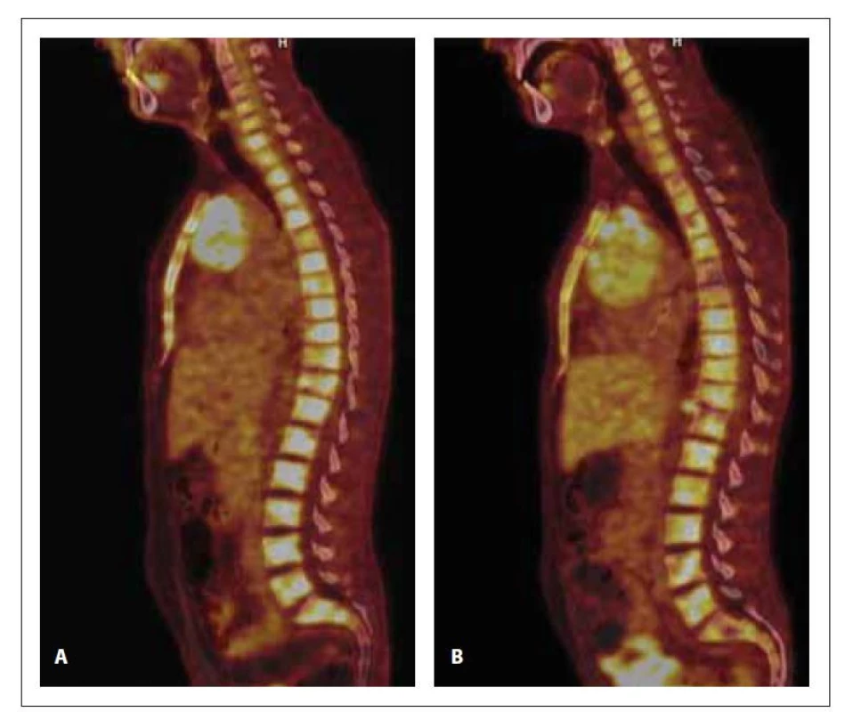 PET/CT a CT skeletu v době diagnózy (A) a po 1. konsolidaci (B). Na
snímku A (PET/CT) je ve všech úsecích páteře, v obou klíčcích a lopatkách,
ve sternu, v pánvi, v proximálních partiích obou humerů a femurů přítomna
zvýšená akumulace 18F-FDG (SUVmax 8,9). Na snímku B (PET/CT) a je prokázána
zvýšená akumulace 18F-FDG (SUVmax 7,6) nehomogenně difuzně v celém
zobrazeném skeletu.
