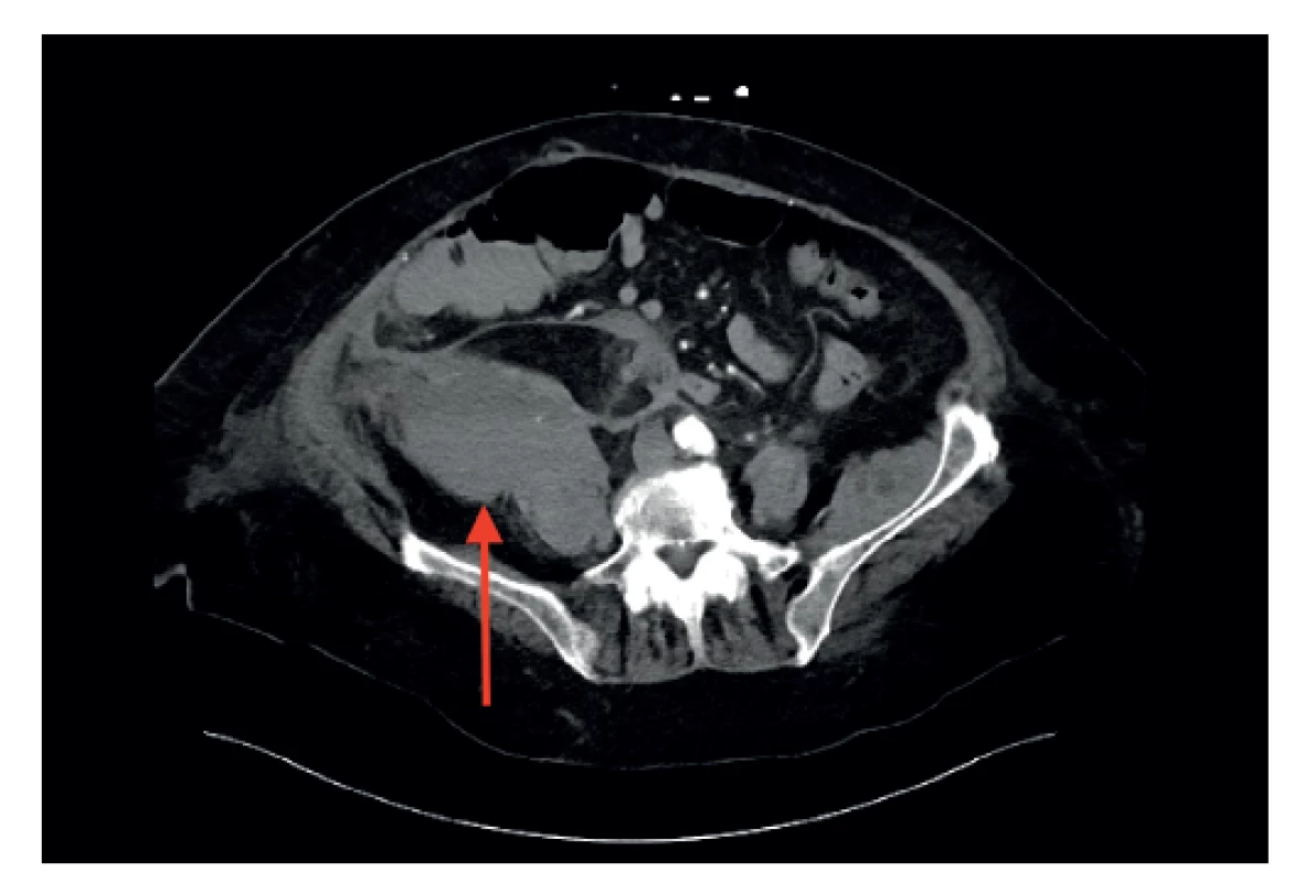 Pacientka 2, CT vyšetření ve venózní fázi, hematom
pravého retroperitonea značen šipkou<br>
Fig. 2: Patient 2, venous phase CT, large hematoma in the
right retroperitoneum (arrow)