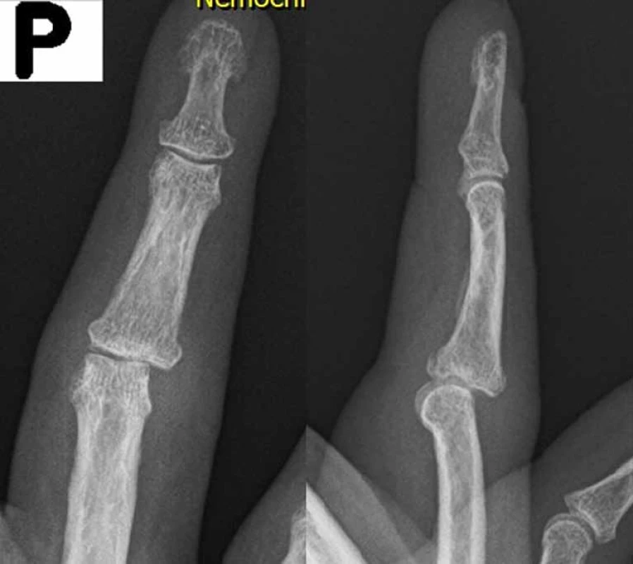 Po dvou týdnech diagnostikována luxační zlomenina s postižením 50 % kloubní plochy