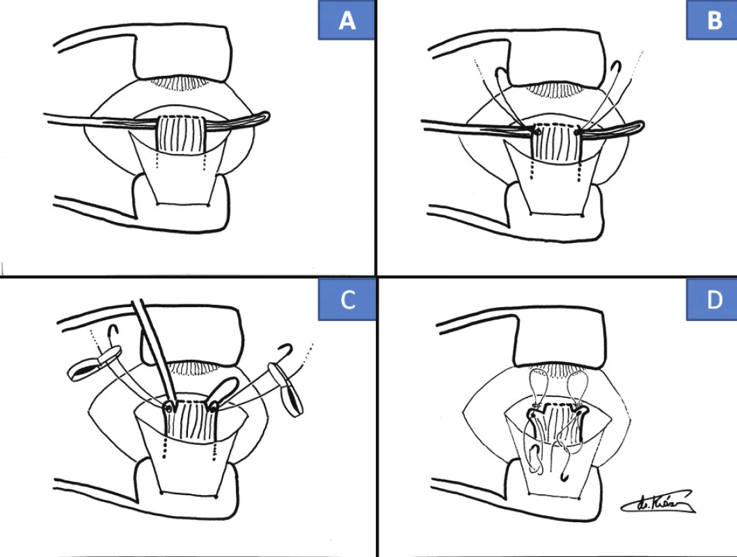 Cul-de-sac surgical technique: drawing of suture into offcut tendon (E), measurement of loop of suture, fixation thereof (F), cutting off of central part of tendon (G), spontaneous loosening of muscle (H)