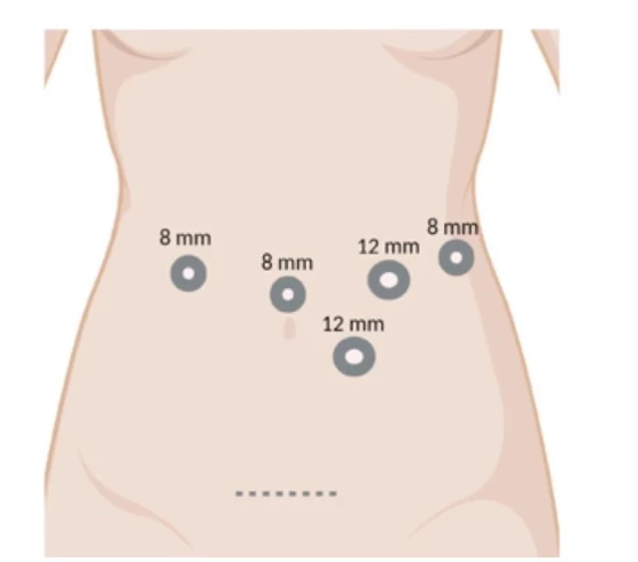 Umístění portů pro robotickou distální pankreatektomii.
Vytvořeno BioRender.com (Č. IV252GCUKL)<br>
Fig. 1: Trocar placement for robotic distal pancreatectomy.
Created with BioRender.com (No. IV252GCUKL)