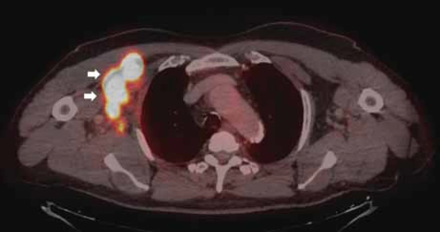 Vstupní PET/CT vyšetření ze září 2018. Šipky značí nádorovou lymfadenopatii
v pravé axile.