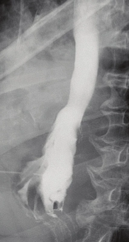 Výsledný RTG jícnu
s kontrastem zobrazující
malý pseudodivertikl
anastomózy, bez
prokazatelného leaku<br>
Fig. 6: The final radiographic
contrast study
depicting a small
pseudodiverticulum in
the anastomosis site,
without demonstrable
leakage