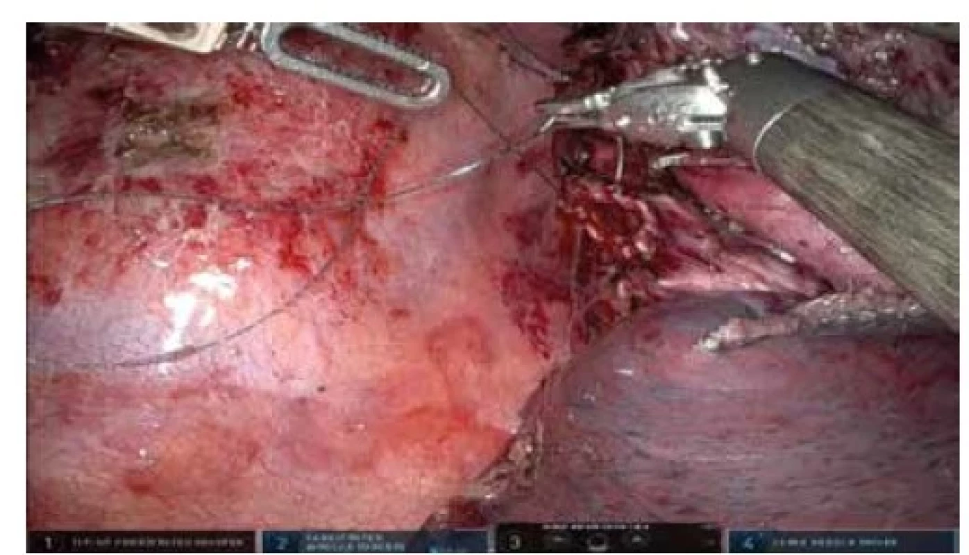 Robotická segmentektomie S6 vpravo, robotická
sutura bronchiálního defektu<br>
Fig. 4: Robotic segmentectomy S6 right, robotic suture of
a bronchial defect