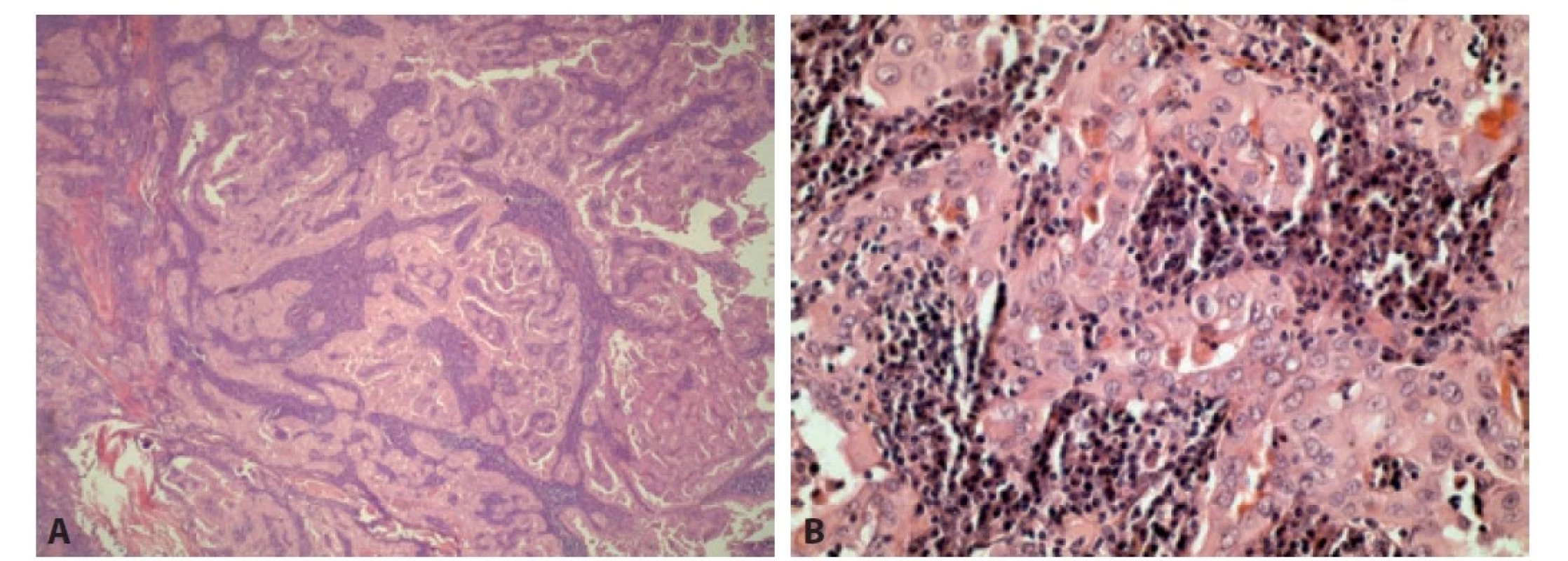 A. Tumor tvořený strukturami papilokarcinomu s onkocytárními elementy s bohatým lymfoidním stromatem (HE, 40x). B. Jaderné znaky
charakteristické pro papilokarcinom (HE, 200x).