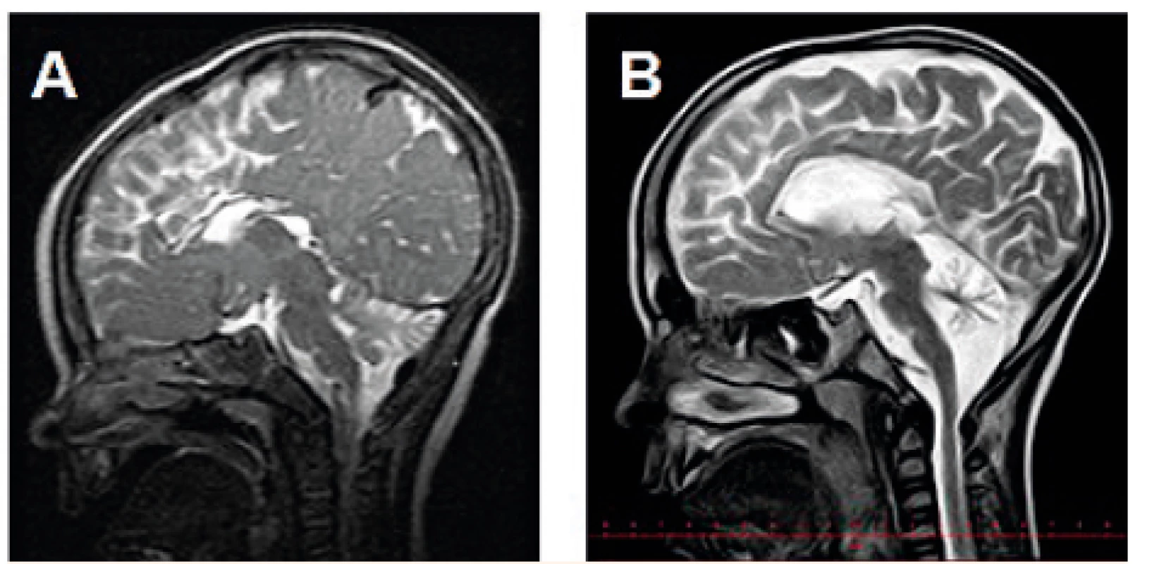 MR mozku (T2W) s progresivní atrofizací mozečku
u chlapce s PMM2-CDG: tentýž pacient ve věku
A – 10 měsíců, B – 6,5 roku.<br>
Fig. 3. Brain MRI (T2W) showing progressive cerebellar atrophy
in a boy with PMM2-CDG: the same patient at the
age of A – 10 months, B – 6.5 years.