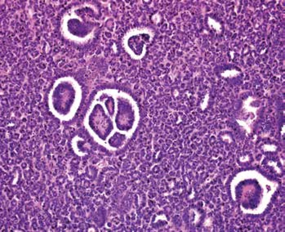 Focally a glomeruloid bodies are apparent (HE, 200x).