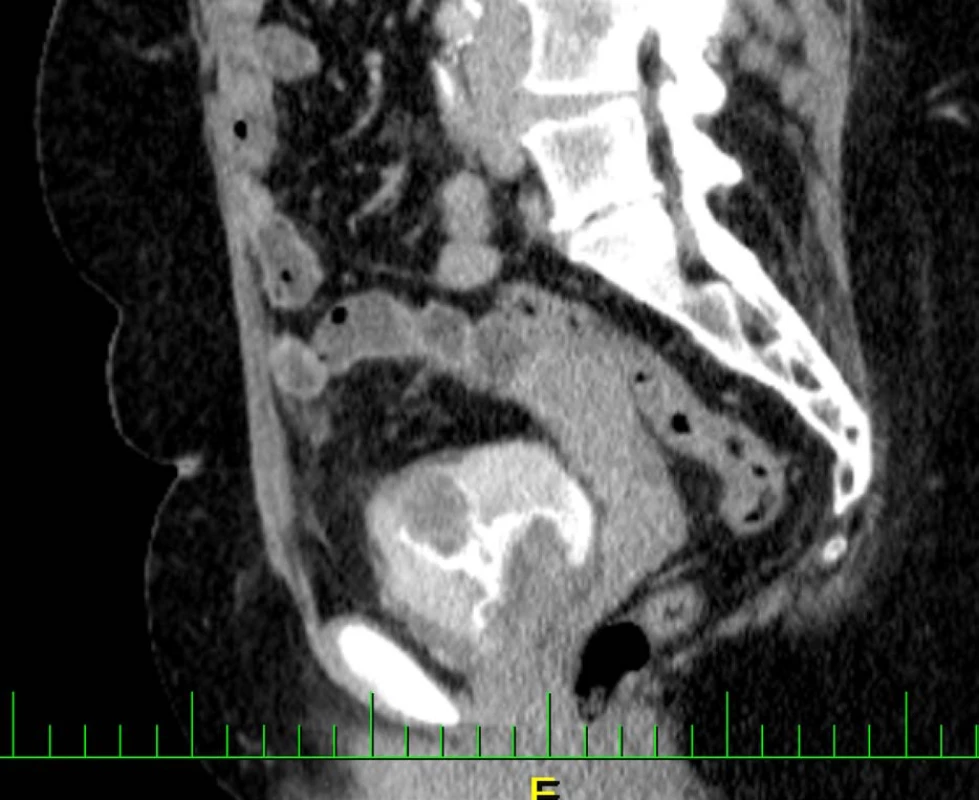 CT vyšetření zachycující intraluminální expanzi v augmentovaném močovém měchýři<br>
Fig. 3. CT examination capturing intraluminal expansion in the augmented bladder