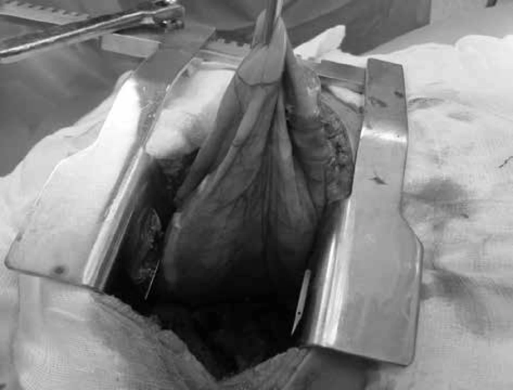 Objemný kýlní vak Morgagniho kýly při resekci
z pravostranné torakotomie<br>
Fig. 4: Large hernia sac of Morgagni hernia resected from
right-sided thoracotomy