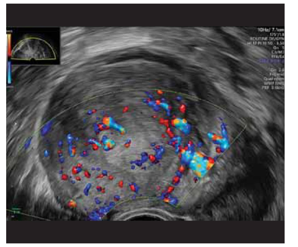 Ultrazvukový nález subserózní myomu s výraznějším
prokrvením, barevná škála 3.<br>
Fig. 2. Ultrasound finding of subserous fibroids with more
pronounced blood supply, color scale 3.