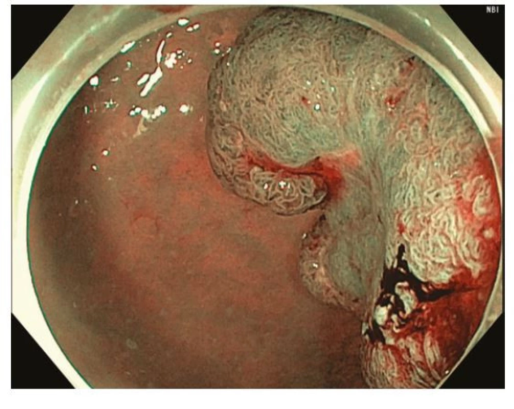 Endoskopická submukózní disekce – přisedlý polyp s centrální
depresí (0-Is + IIc) v rektu