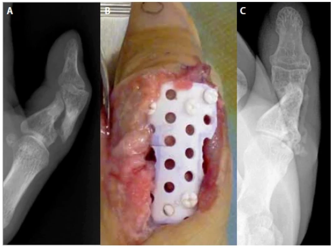 Radiographic and macroscopic evaluation (case 1).  <br> 
A) Preoperative X-ray
(posterior-anterior view); B) operative finding; C) postoperative X-ray (posterior-
-anterior view) 6 months after mesh plate fixation.