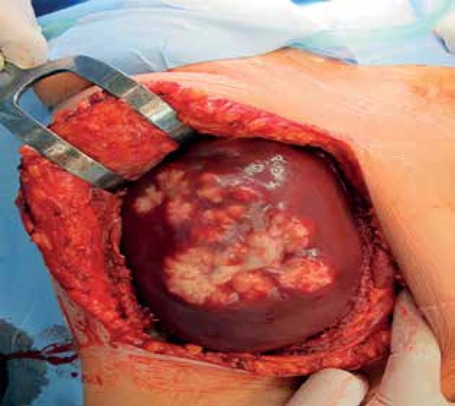 Echinokoková cysta jater<br>
Fig. 1: Echinococcal liver cysts