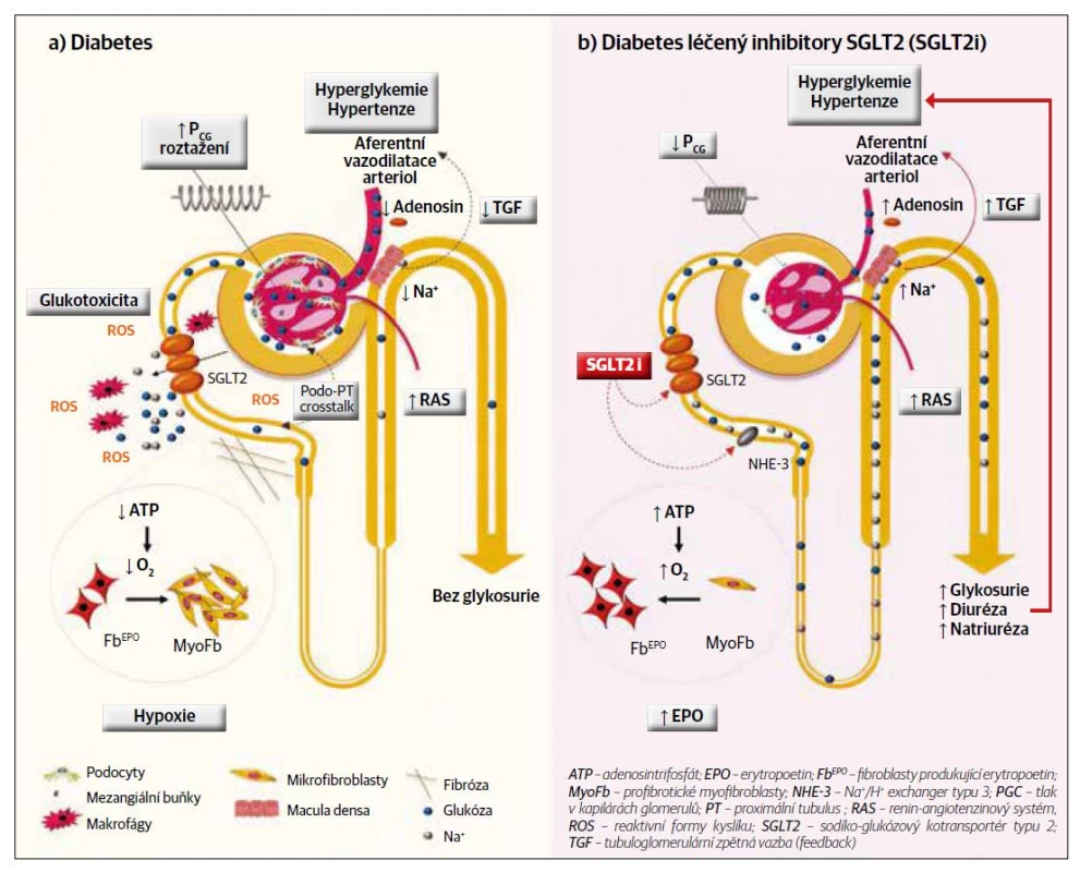 Nefroprotektivní efekt inhibitorů SGLT2. [Upraveno podle publikace Barutta F, et al. SGLT2 inhibition to address the unmet needs in diabetic nephropathy.
Diabetes Metab Res Rev 2019;35:e3171.]