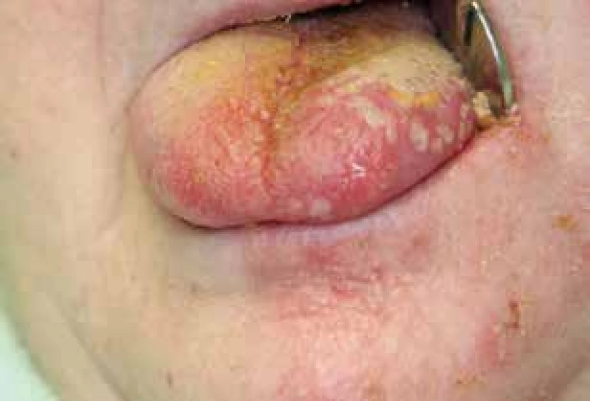 Herpes zoster n. trigemini 