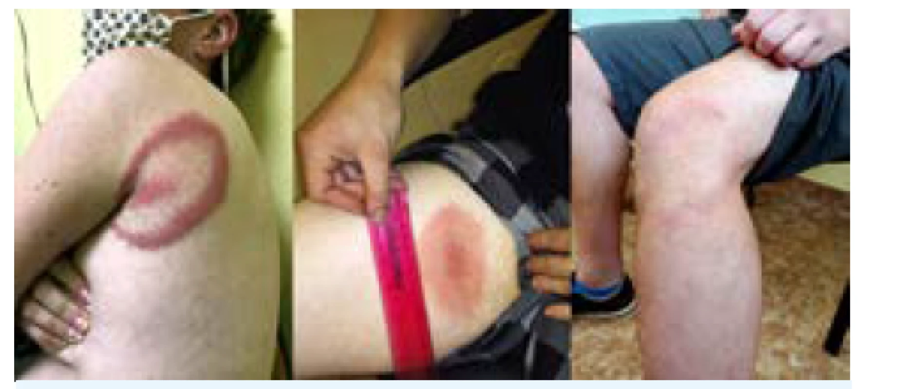 Erythema migrans