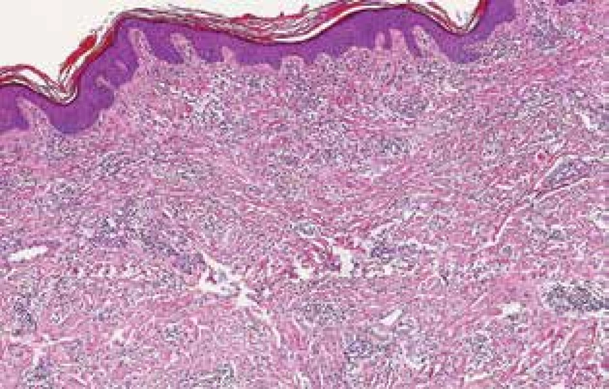 Histologický obraz fibrózního uzlu z oblasti pravého
loktu – sklerotizace kolagenního vaziva a  hluboké řídké perivaskulární a intersticiální infiltráty lymfocytů s plazmocyty