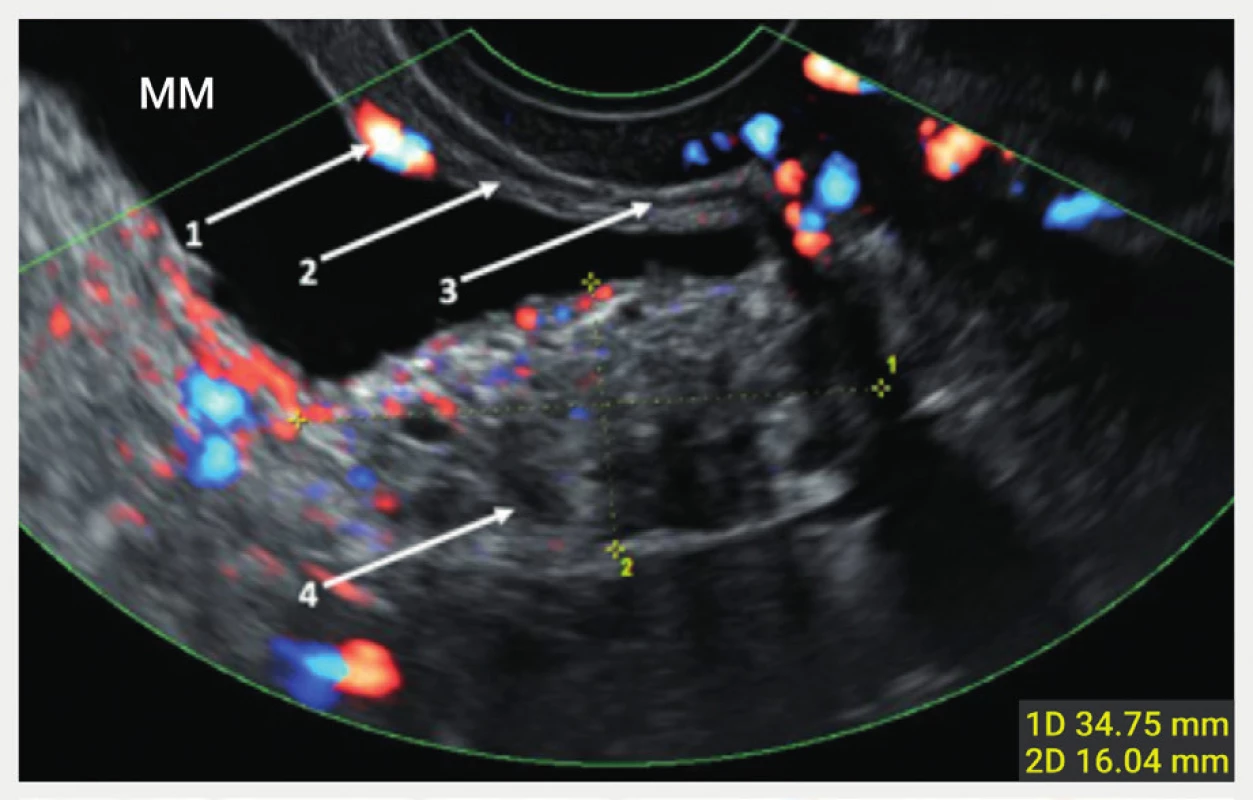 Vrstvy močového měchýře při zobrazení ultrazvukem<br>
Ultrazvukový nález močového měchýře s hlubokou endometriózou
(ohraničena kalipery) v oblasti baze měchýře.
1 – ústí močovodu, 2 – submukóza, 3 – svalová vrstva, 4 – hluboká
infiltrující léze zasahující až do submukózy
MM – močový měchýř