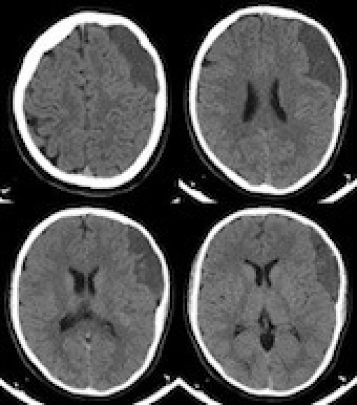 The patient`s CT scan at admission showing a stable arachnoid cyst.<br>
Obr. 3. Pacientovo vstupní CT mozku zobrazující stabilní arachnoideální cystu.

