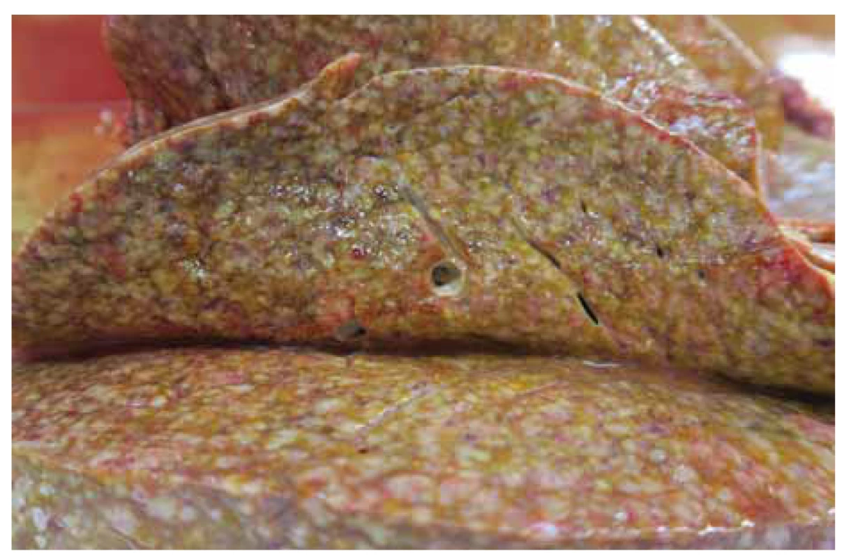 Makroskopický pohľad na pečeň pri pitve.<br>
Fig. 6. Macroscopic view of the liver at autopsy.