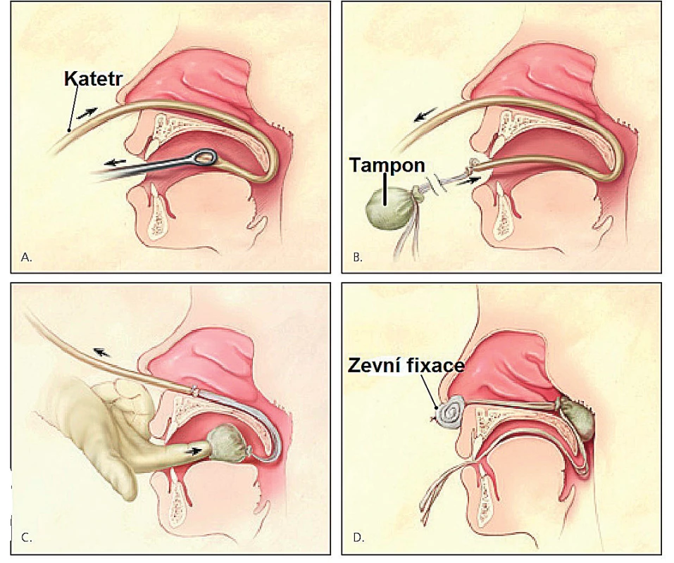 Provedení zadní tamponády nosohltanu (upraveno dle
emdocs. net).