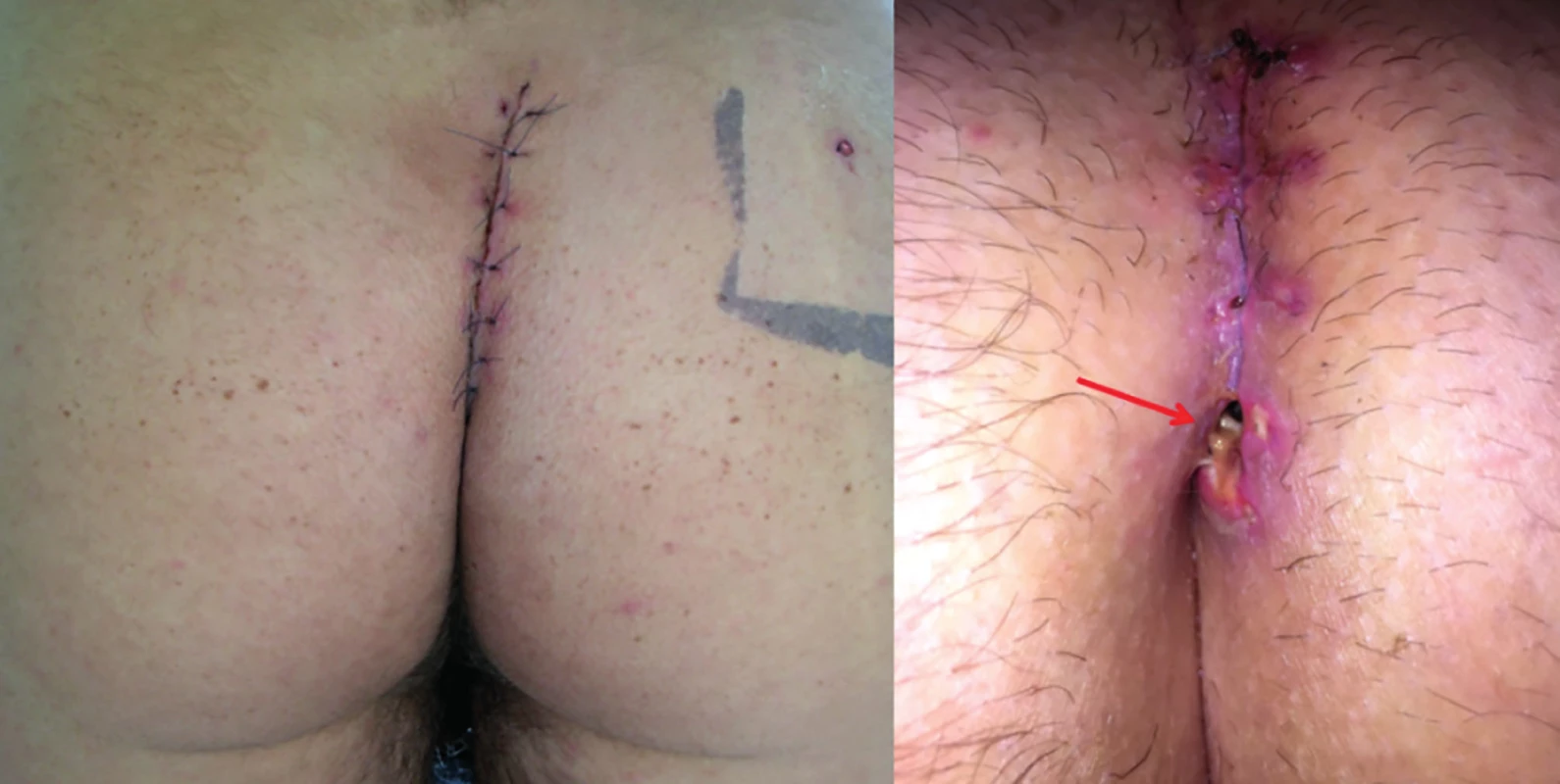  Nedostatečná lateralizace u Karydakisovy plastiky<br>
Fig. 7: Failed Karydakis flap-poor lateralization 