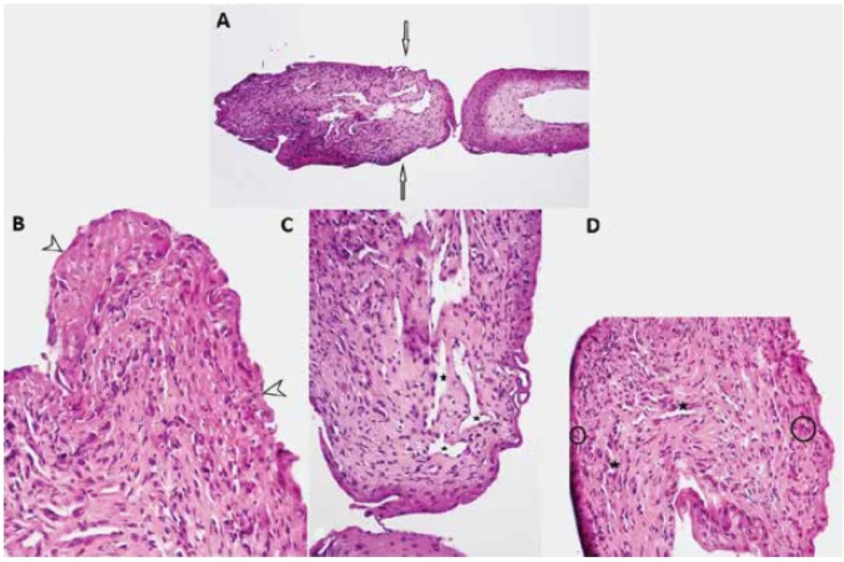 Microscopic examination of the excised lesion with Hematoxillin and Eosin staining shows superficial corneal
tissue attached to an elevated lesion (A) [arrows], with loss of superficial epithelium which was replaced by fibrino-leukocytic
exudate (B) [arrowheads]. underlying connective tissue stroma was fibrous and revealed numerous endothelial
cell lined capillaries (stars) with perivascular inflammatory infiltration (circles) and thick bundles of collagen fibers
throughout the stroma (C, D)