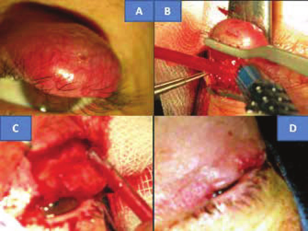 Clinical finding of solid MCC of upper eyelid in 48 year old
patient (A). Surgical procedure: removal of eyelid (B, C) with subsequent
plastic surgery (D)