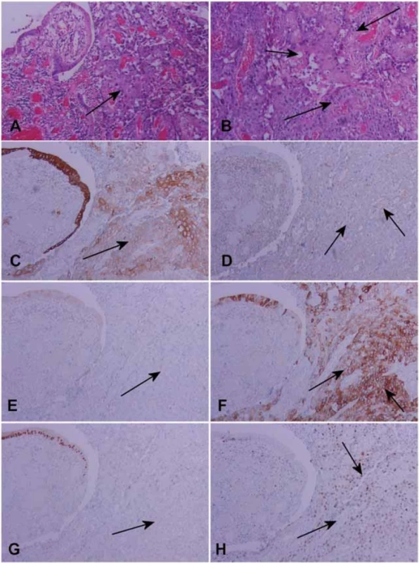 Histologicky sa preukázal nízko diferencovaný epidermoidný karcinóm (A, B), grade 3. Nádor vykazoval imunoprofi l: antibody AE 1/3 + (C) , vimentín slabo + (D), cytokeratín CK 7 – (E) , CK 20 + (F), CDX2 – (G), proliferačný index Ki67 + 90 % (H), HE, IHC-
-Px, 200x.