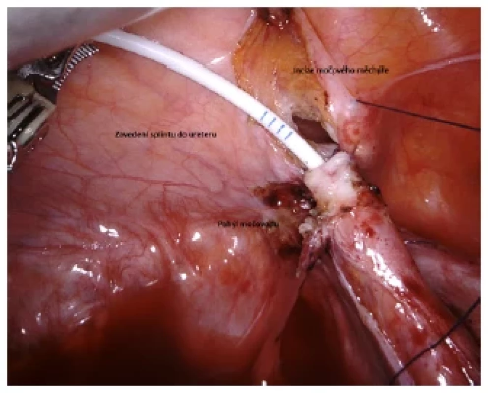 Zavedení splintu do močovodu <br> 
Fig. 4. Insertion of the splint into the ureter