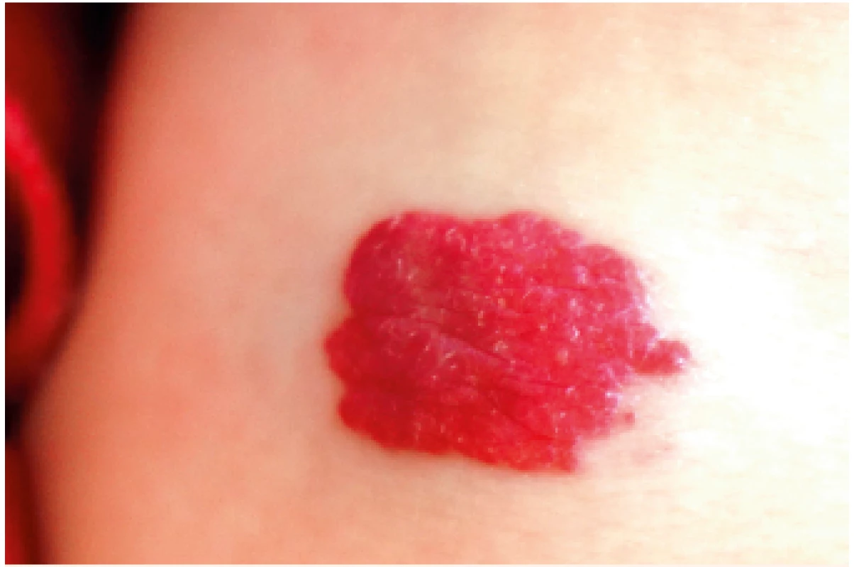Nevýznamný hemangiom.<br>
Insignificant hemangioma.