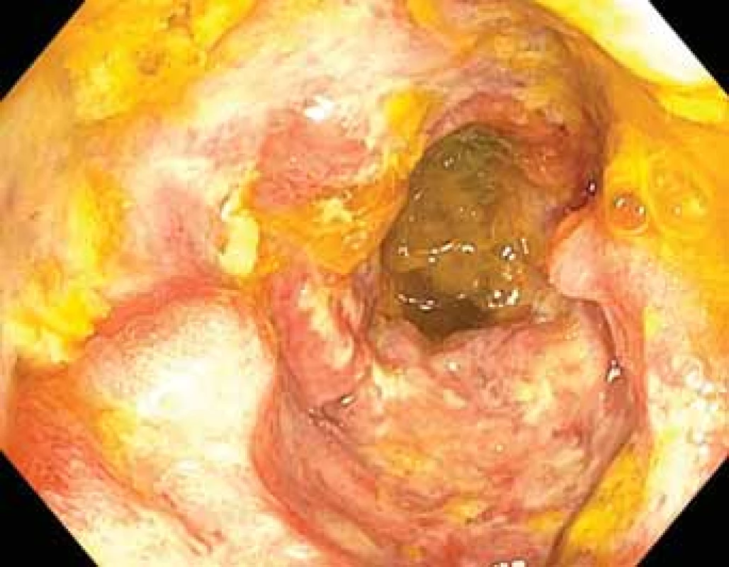 Difuzní velkobuněčný B-lymfom ilea.<br>
Fig. 4. Diffuse large B-cell lymphoma of the ileum.