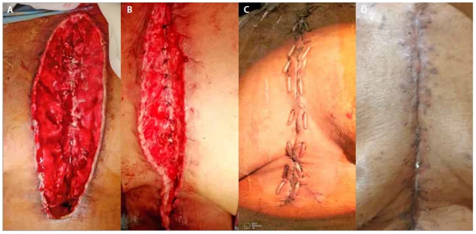 A) Deep sternal wound infection – pre-operatively; B) after bilateral pectoral flap inset; C) day 10 after flap
operation; D day 20 after flap operation.
