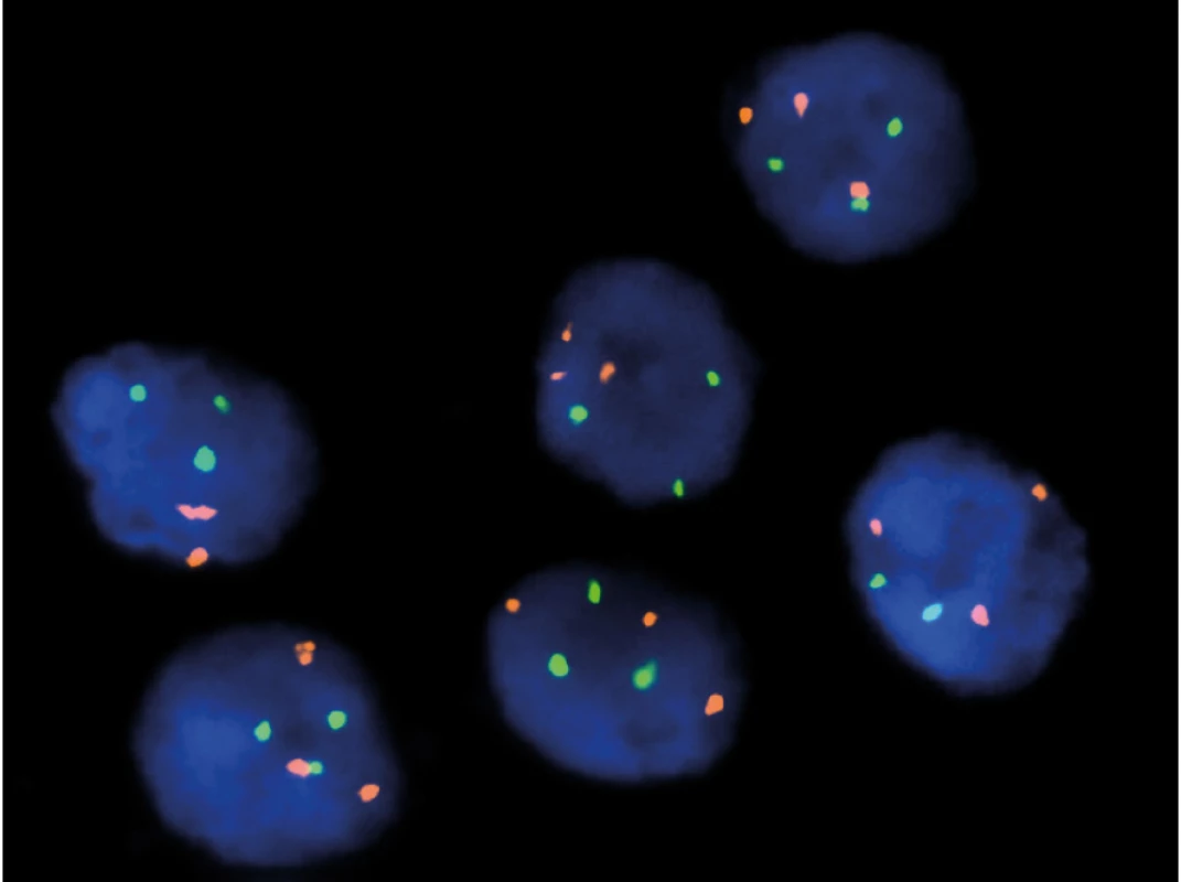 FISH – 7/17 trisomie u papilárního renálního
karcinomu, typ 1<br>
Fig. 1. FISH – 7/17 trisomy in papillary renal cell
carcinoma, type 1