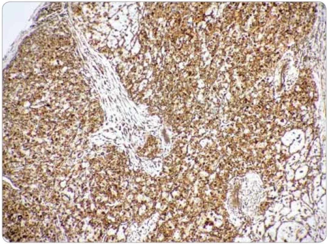 Imunohistochemická cytoplazmatická pozitivita nádorových buniek na dezmín (zväčšenie 20×).