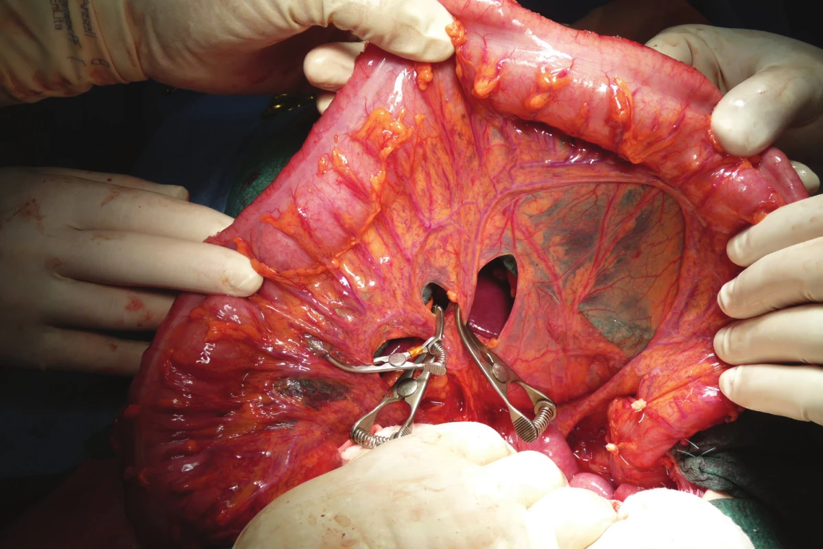 Ověření vitality
střevní stěny po naložení
cévních svorek na větve
a. colica media, které
budou podvázány<br>
Fig. 2: Validation of the
vitality of the intestinal
wall after loading of the
vascular clamps onto the
branches of the middle
colic artery to be tied up