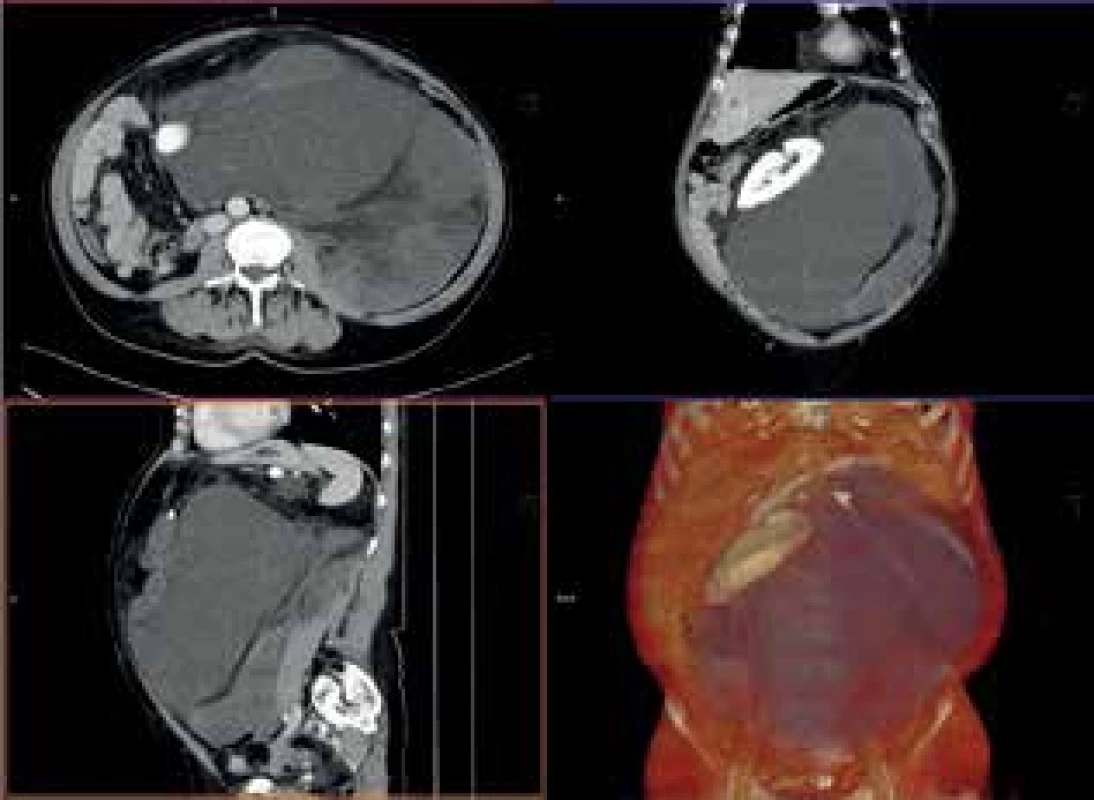 CTA obraz tumoru <br>
Fig. 6: CTA scan of the tumor