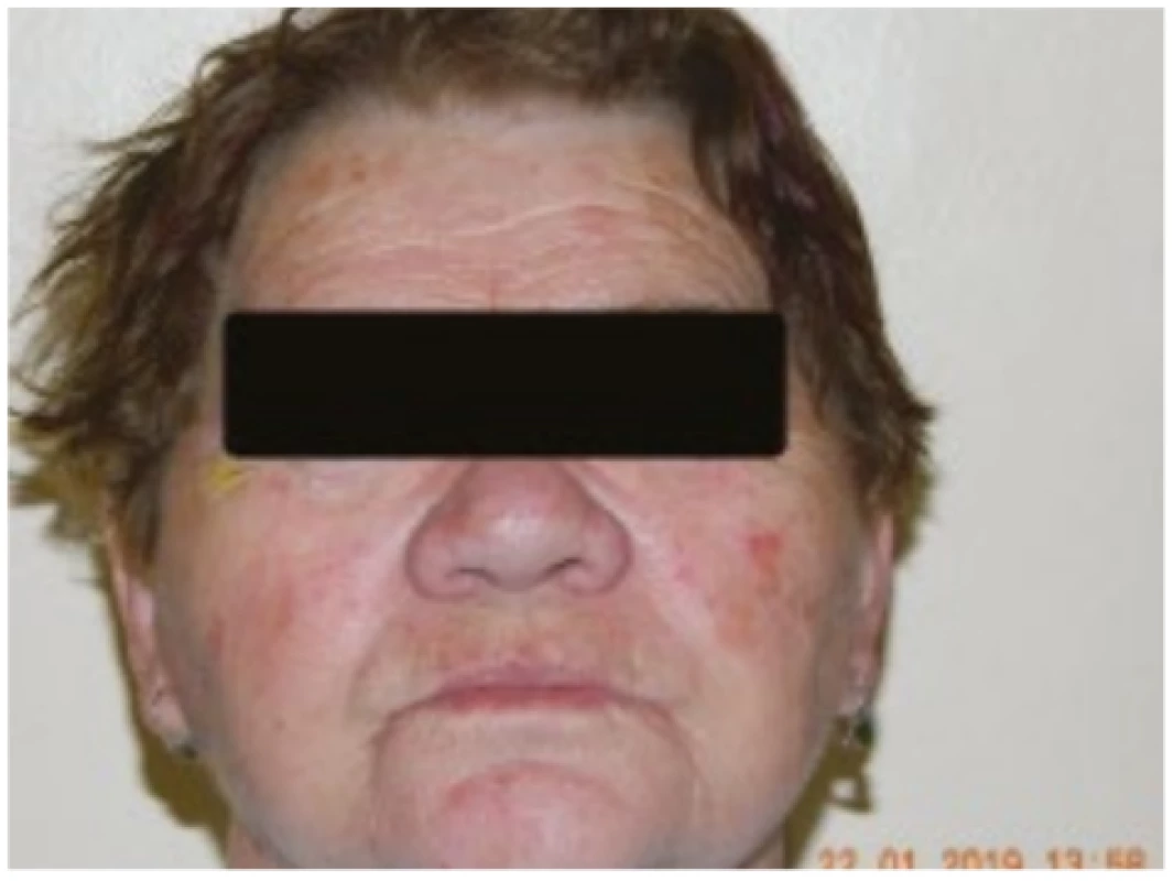Face of patient from case report 2 with long-term
well treated facial rosacea, with isolated actinic keratoses 