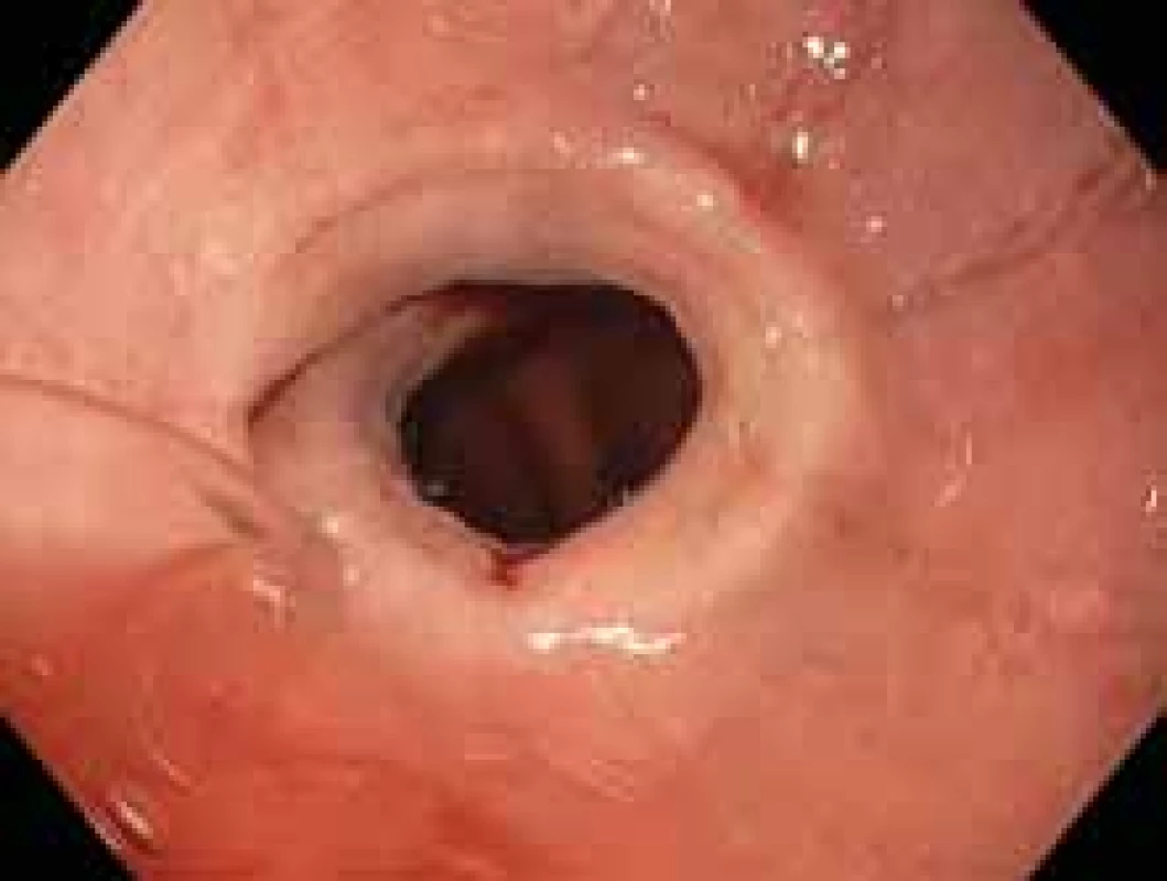 Endoskopický obraz podélných rýh a striktury v oblasti dolního jícnu. <br>
Fig. 1. Endoscopic appearance of longitudinal furrows and stricture of distalesophagus.