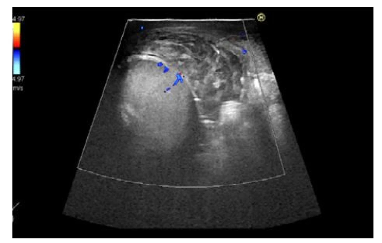 Hematom v měkkých tkáních kolem varlete
po kontuzi o řídítka jízdního kola<br>
Fig. 1. Hematoma in the soft tissues around the
testicle after contusion of the handlebars of a bicycle