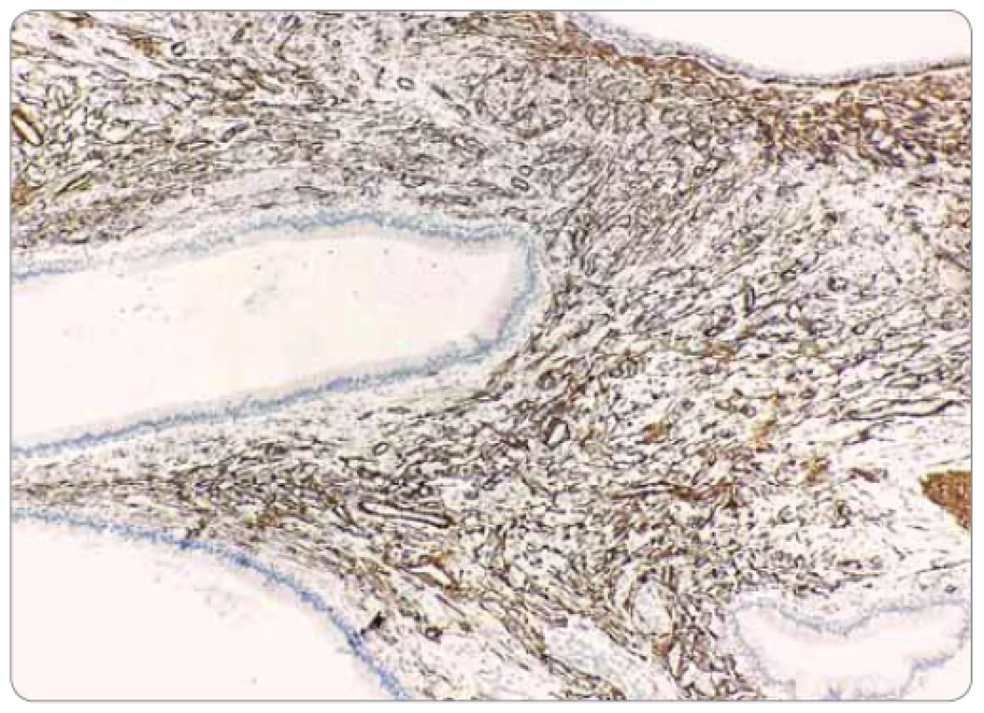 Imunohistochemická reaktivita nádorovobunkovej populácie na α-hladkosvalový
aktín (zväčšenie 100×).