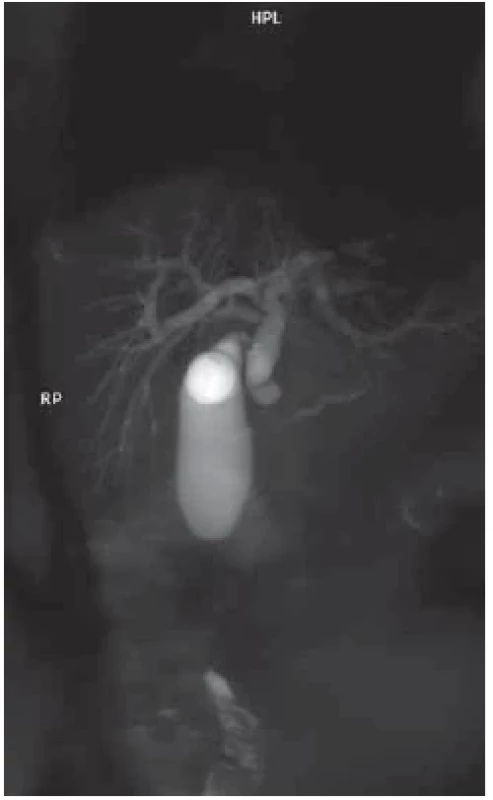 Střední dilatace žlučových cest se
stenózou distální, resp. pankreatické části
d. choledochus a lehká dilatace pankreatického
vývodu na MRCP. <br> 
Fig. 4. Moderate dilatation of the bile ducts
with distal stenosis, or pancreatic part
d. choledochus and slight dilatation of the
pancreatic duct on MRCP.