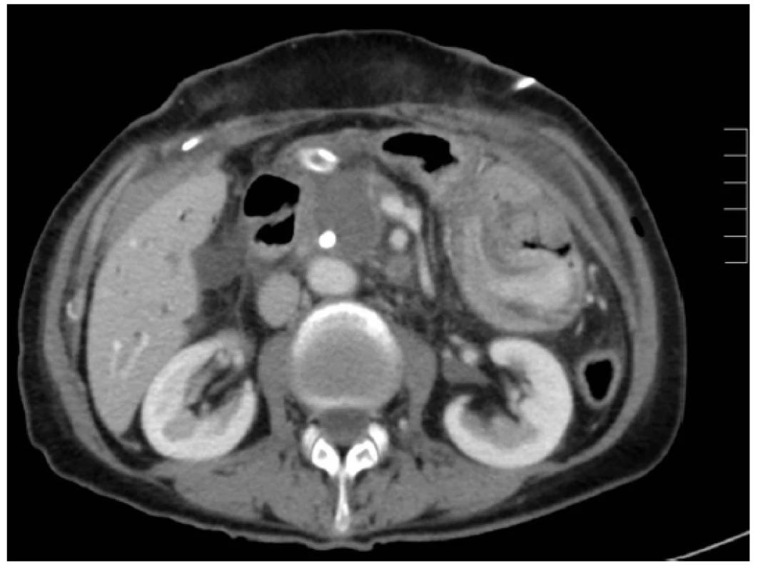Pancreatic head tumour one day after RFA