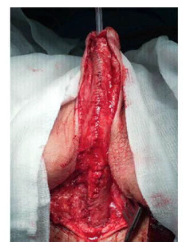 Kompletní tubulizace uretry
v rámci druhé doby uretroplastiky<br>
Fig. 6. Complete urethral tubulization
during second stage of urethroplasty