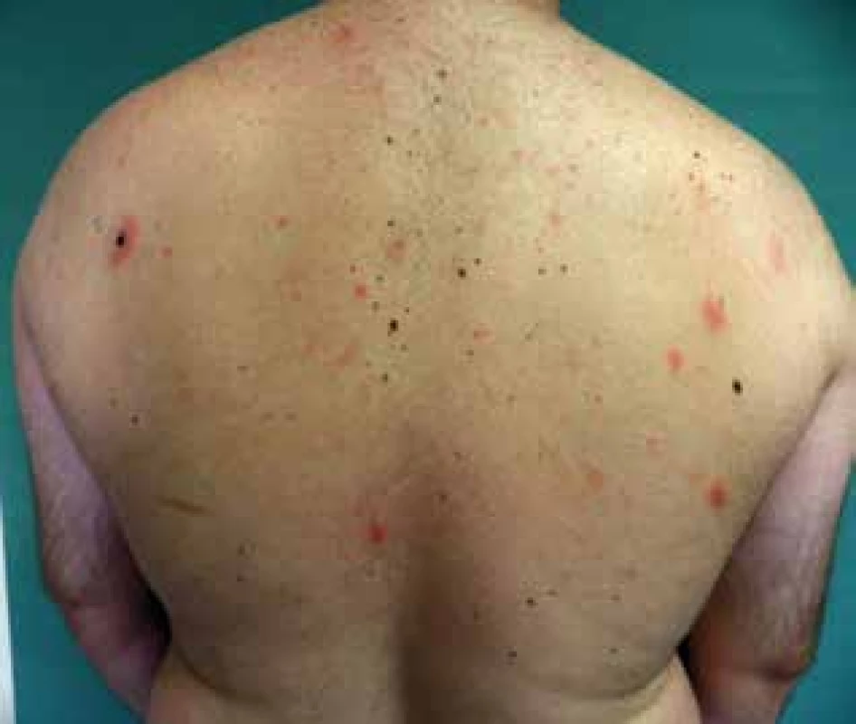 Mucinosis follicularis